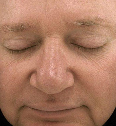 After photo for Robert W.