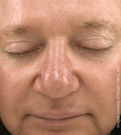 Before photo for Robert W.