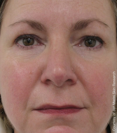 After photo for Emma L.