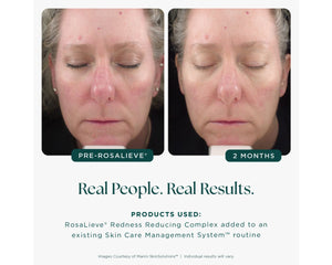 RosaLieve Redness Reducing Complex