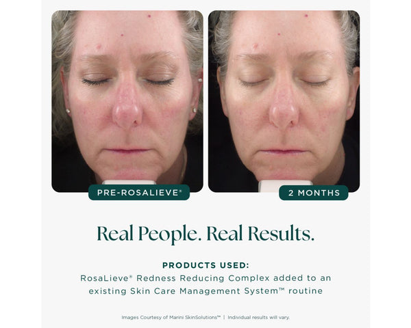 RosaLieve Redness Reducing Complex